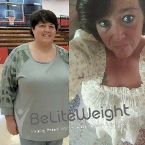 Weight Loss Surgery Before And After